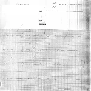 2005 Posterior MI